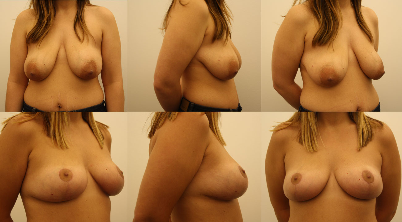 Mastopexy Atalla Plastic surgery