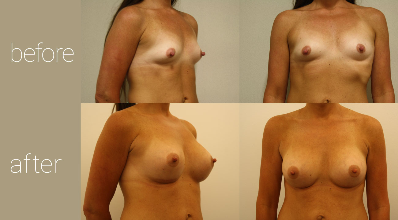 34 year old female | six months status post, 375cc smooth, round submuscular gel implants