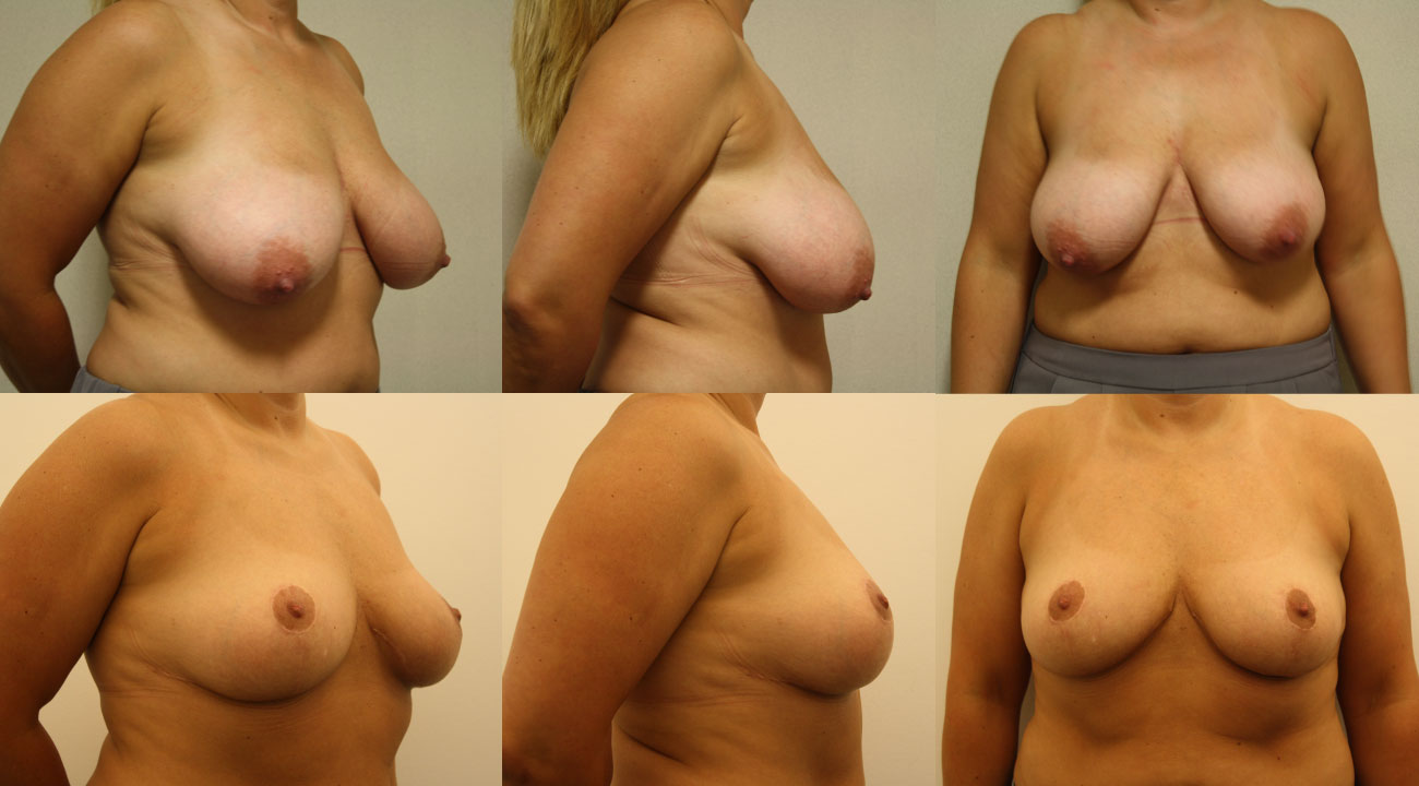40 year old female | three months status post Reduction Mammaplasty, removal of 306gm from right & 218gm from left