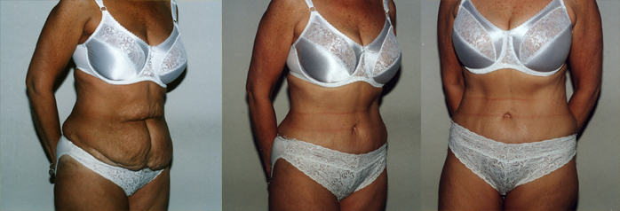 abdominoplasty-tummy-tuck-Atalla-Plastic-Surgery