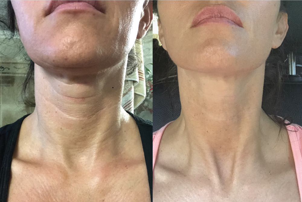 skinade before and neck area