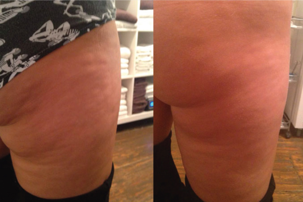 skinade before and after cellulite