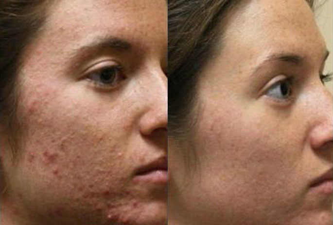 acne treatment skinade