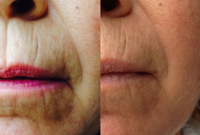 skinade before and after fine lines + wrinkles