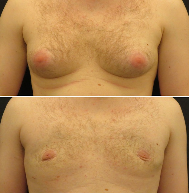 Male Breast Reduction